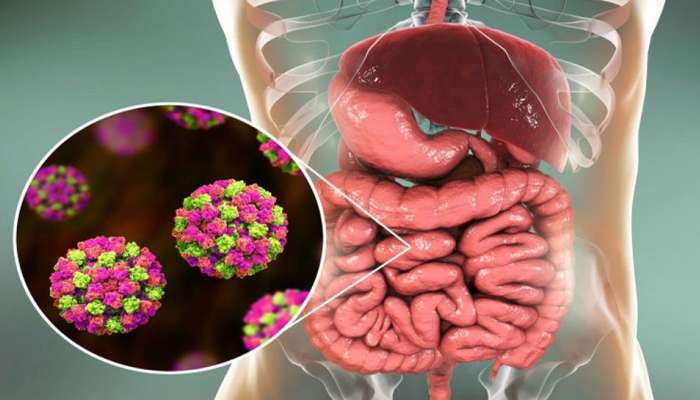 242779-norovirus-symptoms