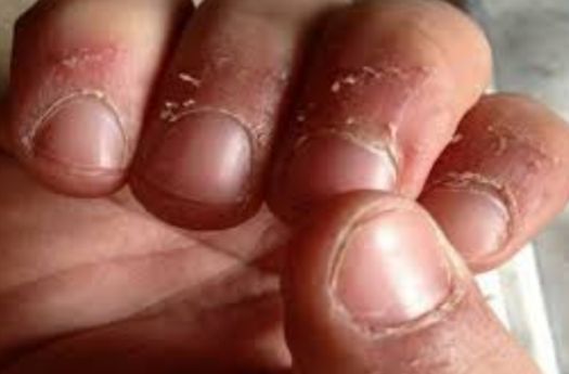 Only itching n redness . Gradually peeling off skin around nail - NEET PG -  www.MedicalTalk.Net the Best Medical Forum for Medical Students and Doctors  Worldwide