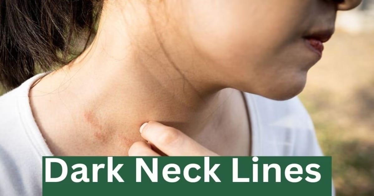 Dark Patches in Neck