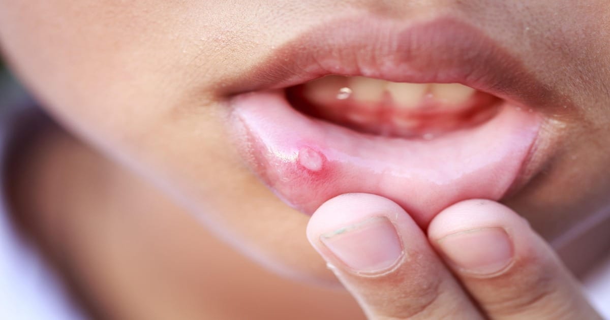 Home Remedies for Mouth Ulcers