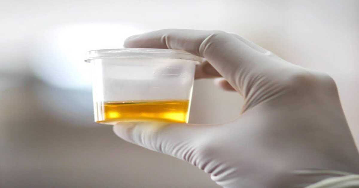 Color of urine