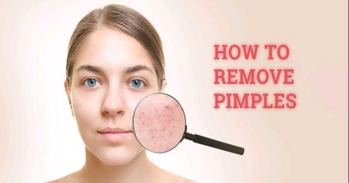 Acne removal tips