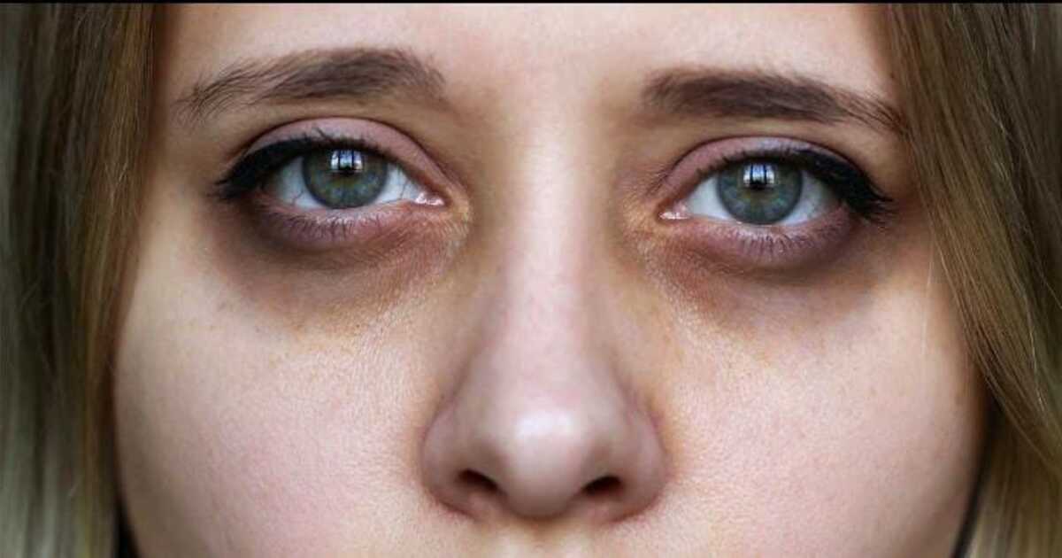 Dark spots under eyes