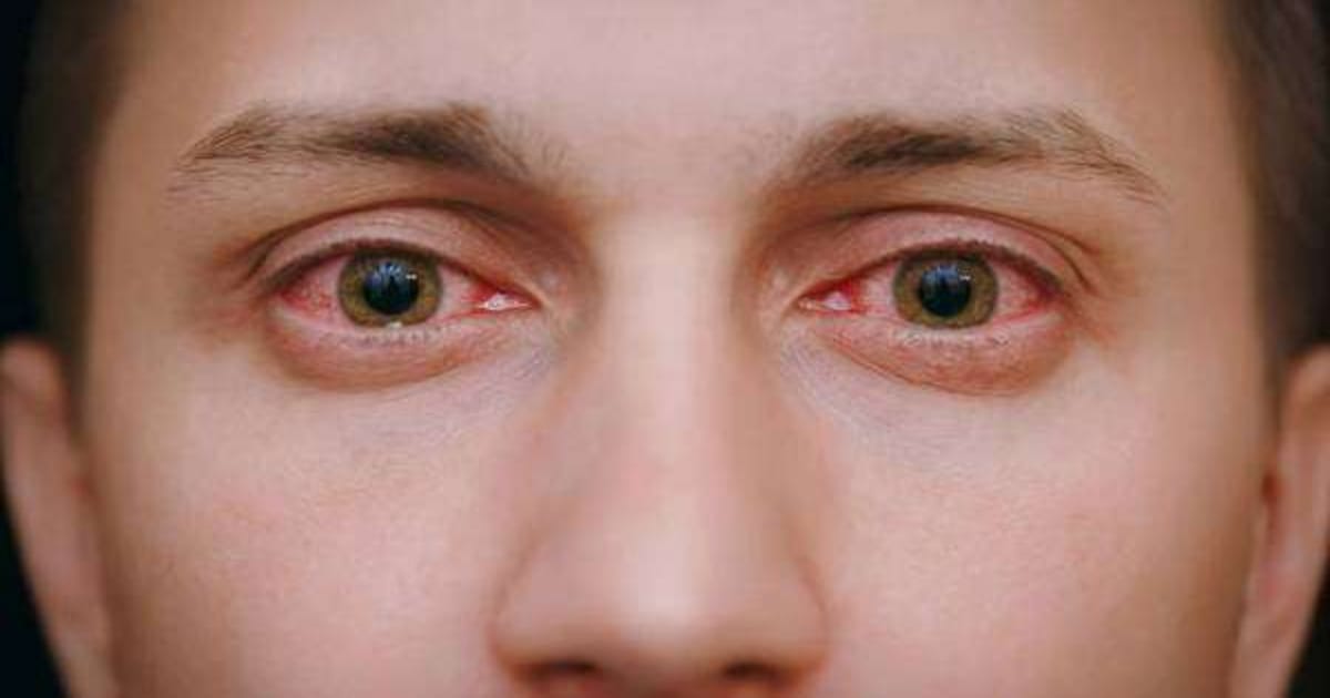 Conjunctivitis