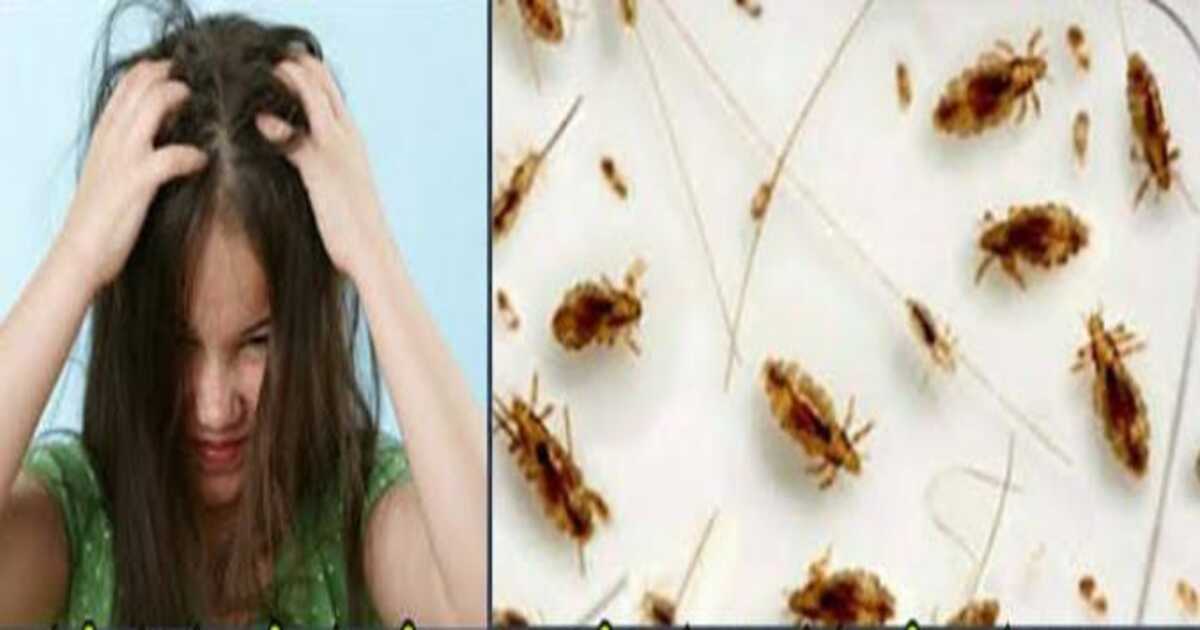 Home remedies for lice