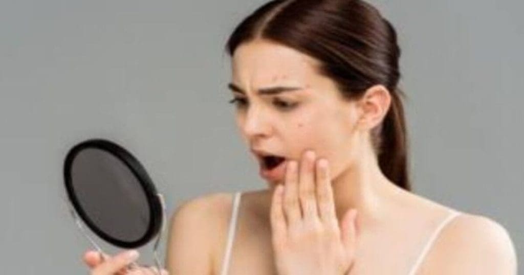 Acne Kissing