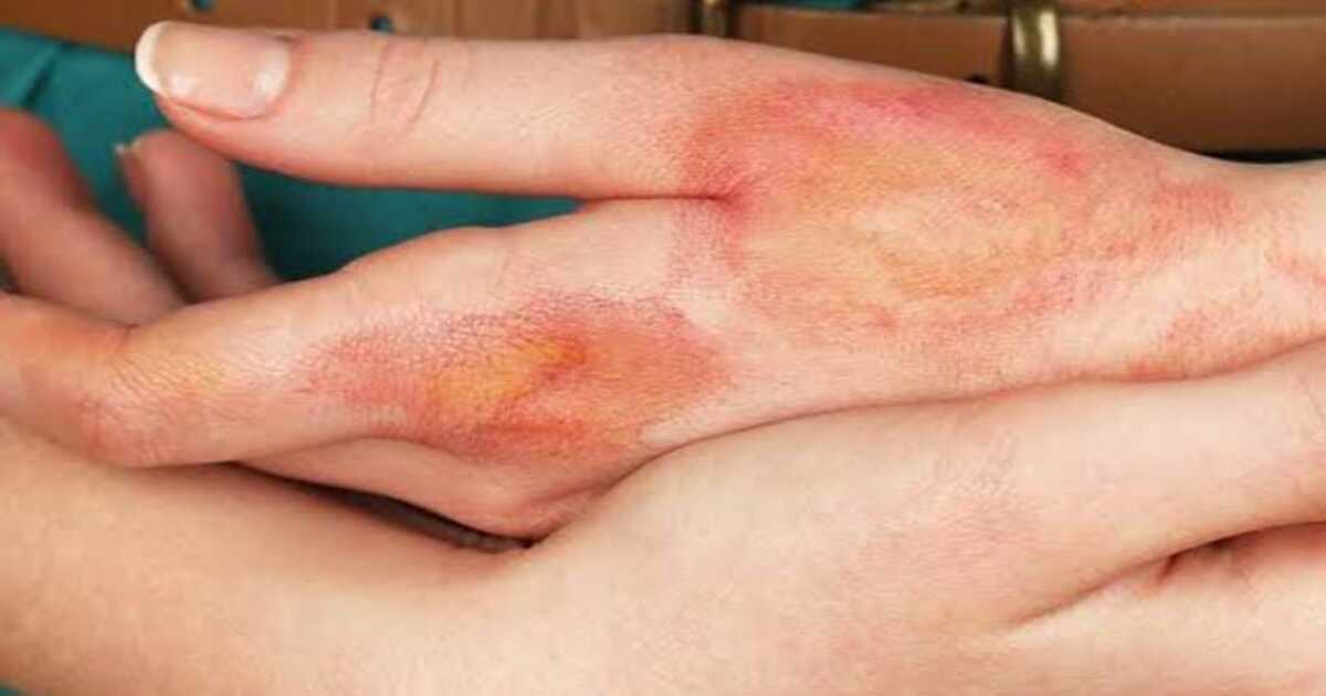 Heal your burns