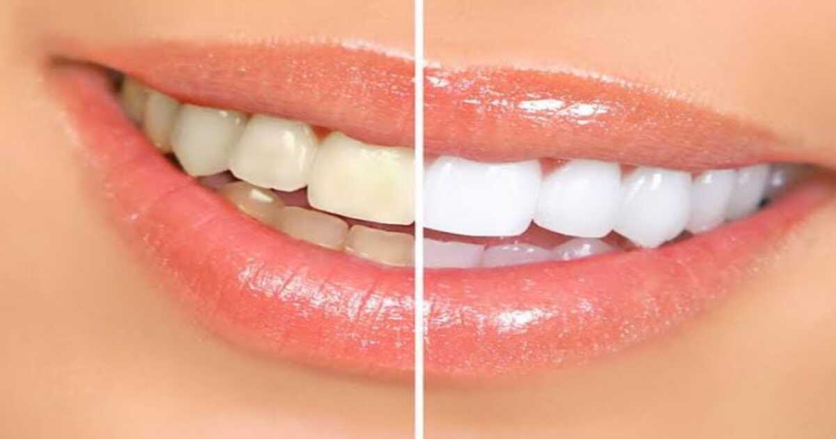 Teeth whitening Tip