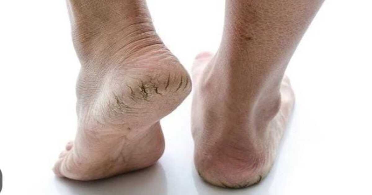 Home Remedy For Cracked Heel