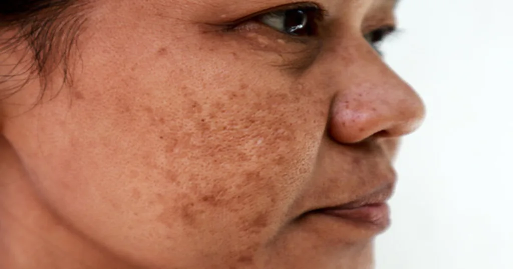 Pigmentation