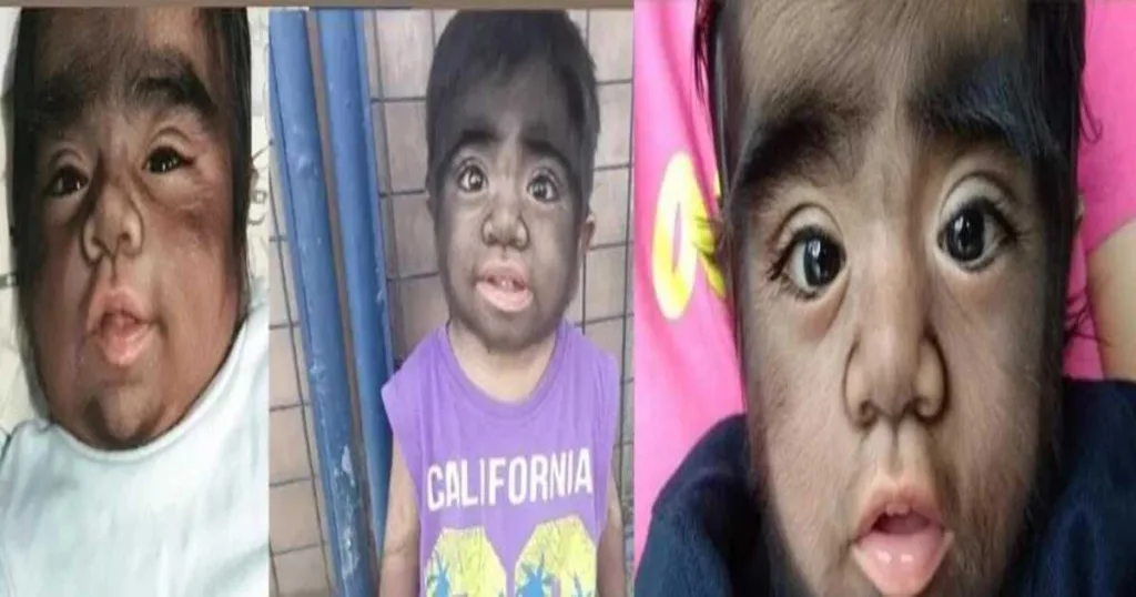 Werewolf Syndrome