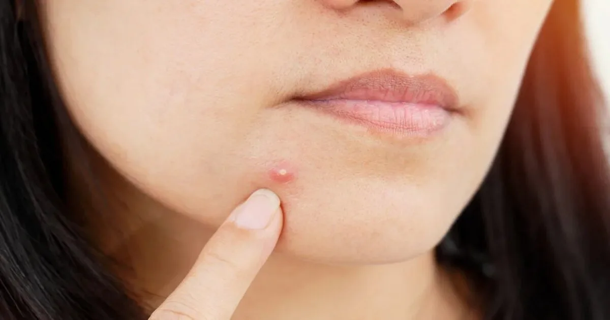 Home Remedies For pimples