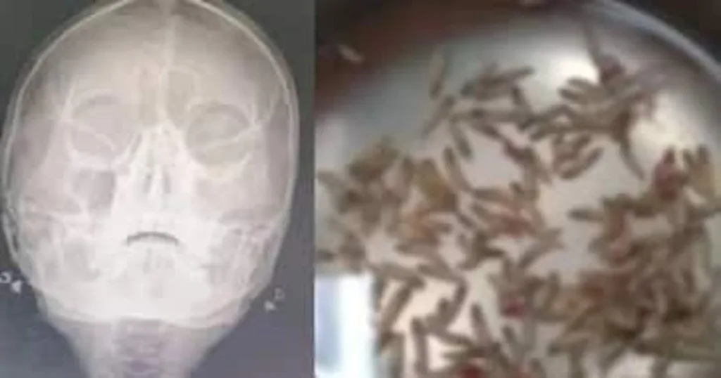 Maggots in Nose
