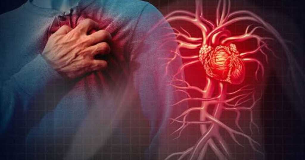Heart Attack