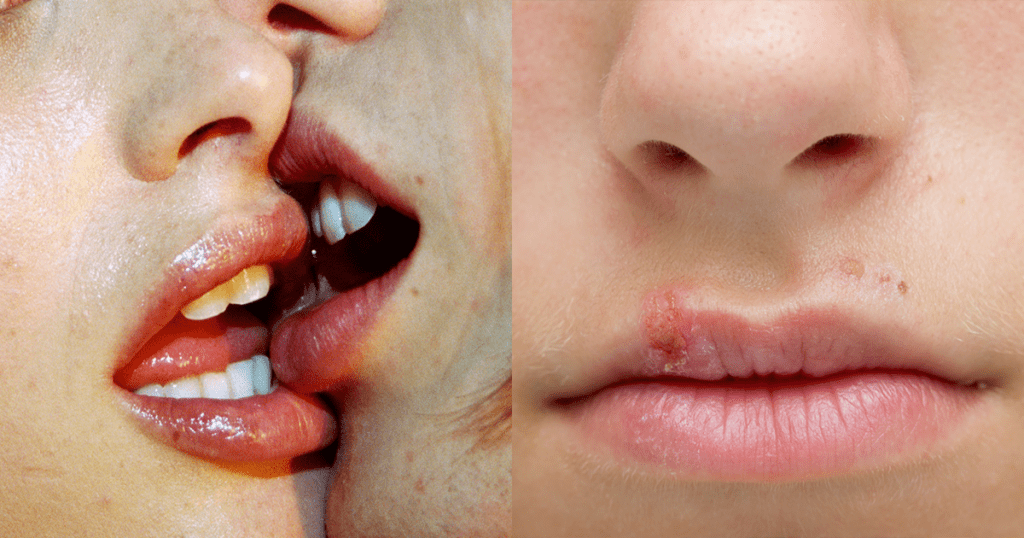 Kissing disease