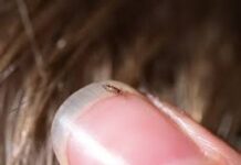 ಹೇನಿನಿಂದ ಜೀವ ಕಳೆದುಕೊಂಡ 6ನೇ ತರಗತಿ ವಿದ್ಯಾರ್ಥಿನಿ!