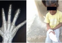 Tumakuru : ಶಾಲೆಯಲ್ಲಿ ಬಾಲಕಿಯ ಕೈ ಬೆರಳು ಕಟ್ – ಚಿಕಿತ್ಸೆ ಕೊಡಿಸದೆ ಬೆರಳನ್ನು ಕಸದ ಬುಟ್ಟಿಗೆ ಎಸೆದ ಶಿಕ್ಷಕರು!!